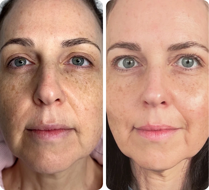 neogen-plasma-machine-before-and-after-2-weeks-1