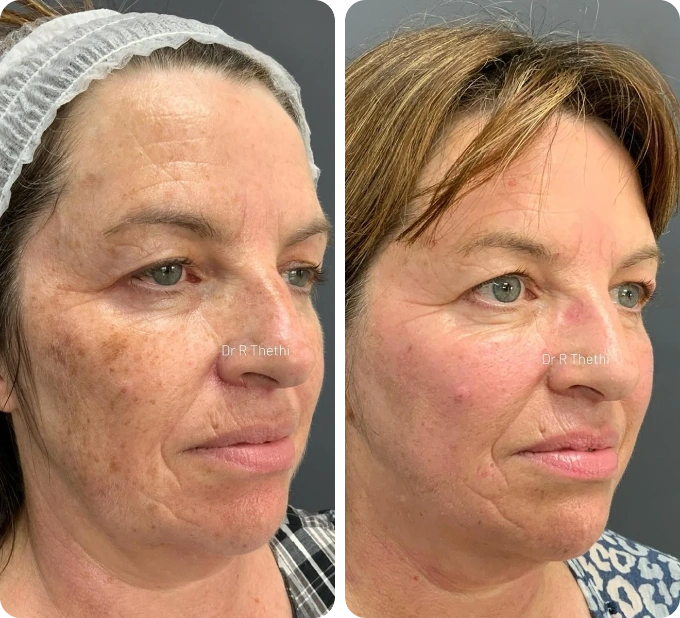 neogen-plasma-machine-before-and-after-2-weeks-2