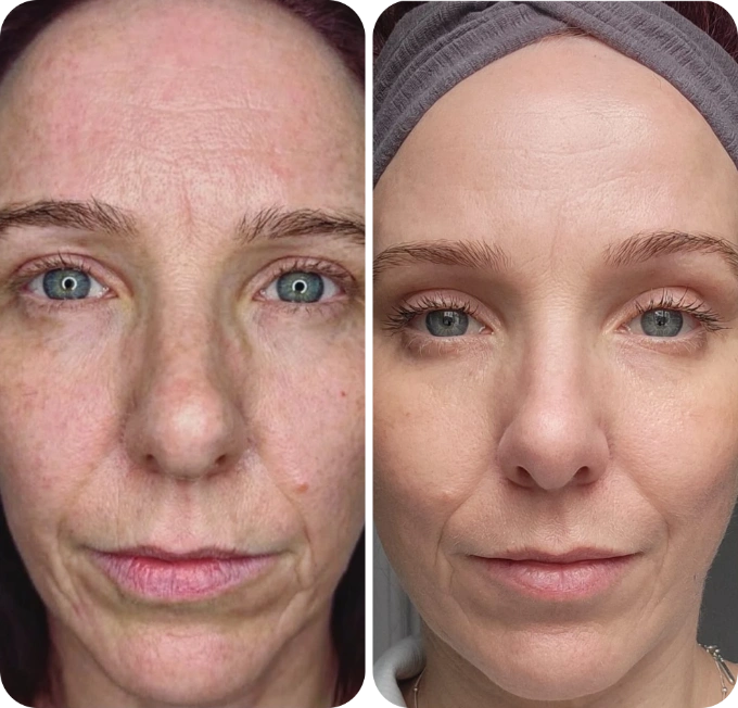 neogen-plasma-machine-before-and-after-3-months