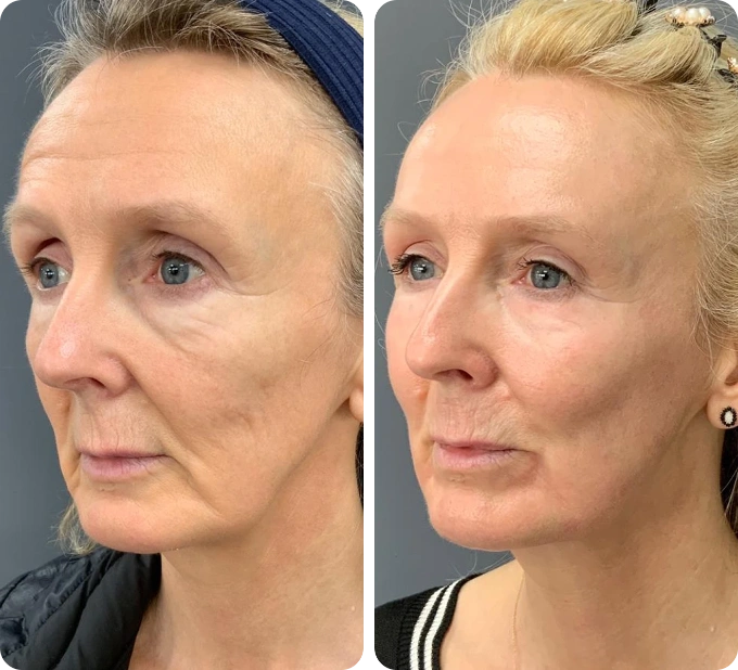 neogen-plasma-machine-before-and-after-4-months